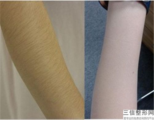 手臂激光脱毛术后保养应该怎么做