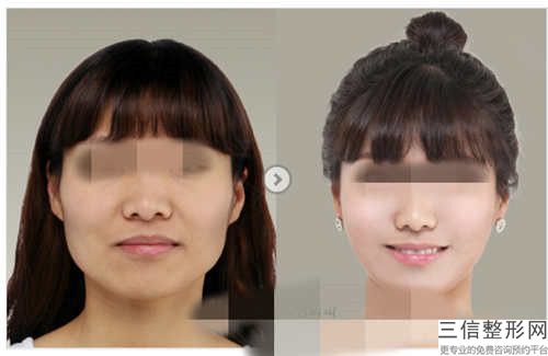 徐艳梅嘴唇疤痕修复后要怎样护理