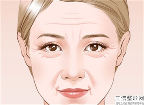 李慧灿Botox注射去法令纹有没有危害呢