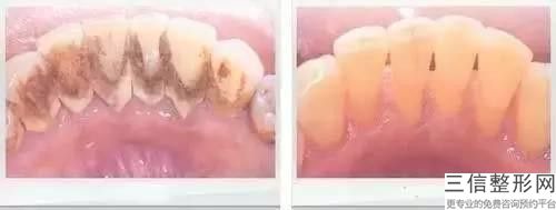 全口烤瓷牙材料好吗，安不安全