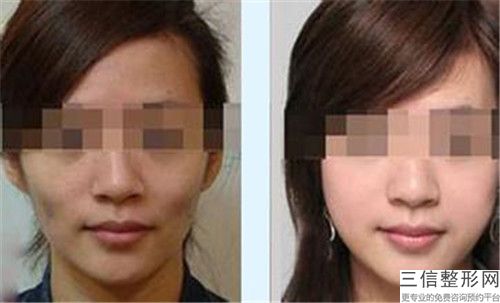 王海鑫脸部脱毛激光会产生哪些副作用和危害