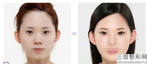 今妃医学美容中心抽脂去眼袋内切去眼袋手术都有哪些明显后遗症