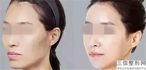 郑楠减肥瘦脸针用哪方法见效快又没副作用