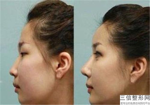 注射隆鼻隆鼻后应如何正确护理