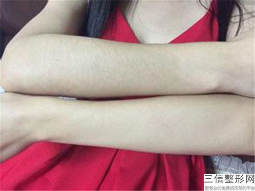 胡子脱毛手术术前注意事项及术后护理事项有哪些