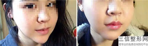 激光唇部脱毛会造成伤害吗,激光唇部脱毛对皮肤有伤害吗