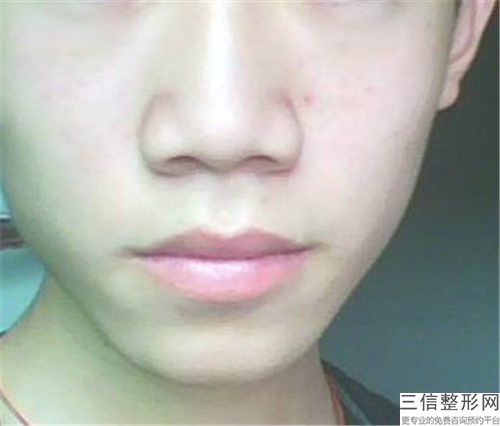 达拉斯自体软骨隆鼻会对身体产生什么伤害