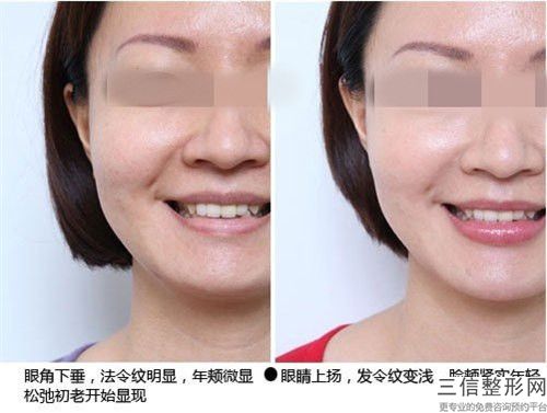 botox去抬头纹手术的副作用有什么呢
