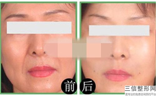 去抬头纹术一般维持多长时间