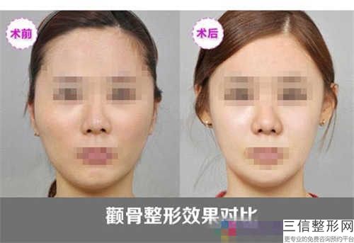 全国下颌骨纠正出名的整形医生：下颌骨纠正医生前50强实力之选