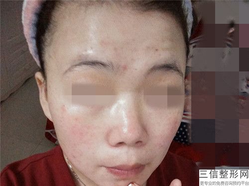 外阴切痣手术过程安全不安全_外阴切痣手术的安全性有多高