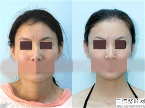 抚州市下颌骨掉下来好的医院(抚州市梦婷医疗整形美容诊所凭技术蝉联前几)