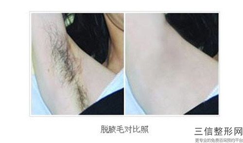 唇部激光脱毛危害包括哪些,唇部激光脱毛会有失败的风险吗