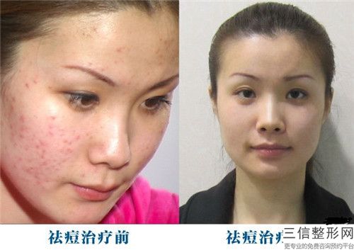 国内耳洞瘢痕疙瘩去除比较有名的医生：耳洞瘢痕疙瘩去除医生前50综合发布