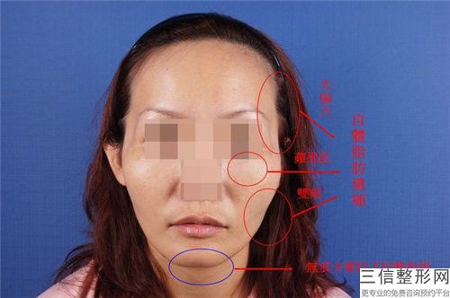 取玻尿酸下巴手术适应人群与禁忌症