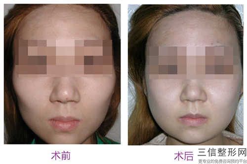 合肥市抽脂下颌缘医生排名十强安利-西奥•瑞吉克医生简介_案例图片