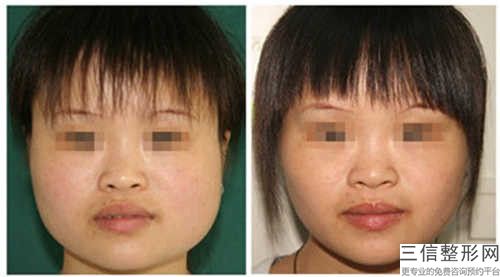 宜宾市隐形牙套打骨钉牙科哪家好-宜宾雅美口腔诊所身经百战