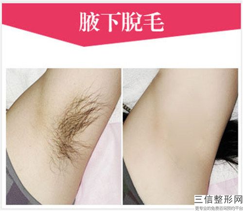 人工毛囊植发的6大人群