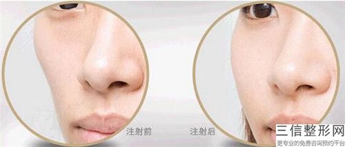 打瘦脸针手术对身体损害有多大