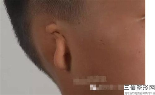 中国知名先天性耳朵畸形再造医院：先天性耳朵畸形再造医院前50佳靠谱名单公布
