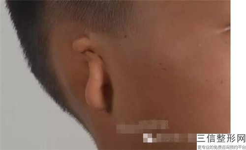 直埋法耳再造之后有没有副作用