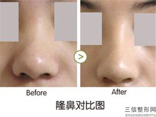 做鼻头大缩小手术医生推荐全国：做鼻头大缩小手术医生前50名揭秘
