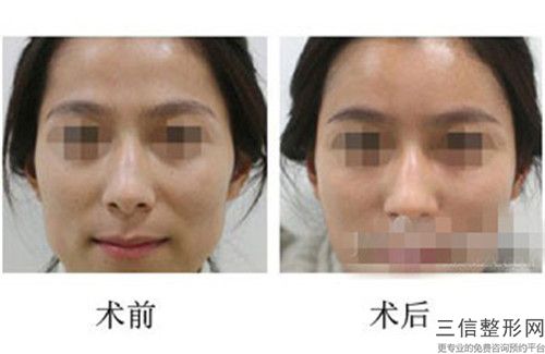 整容苹果肌效果的因素是什么