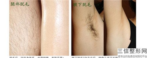 半导体冰激光脱毛后保养方式