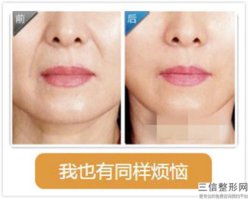 激光去皱纹术后修复副作用「激光去皱纹操作不当会有副作用吗」