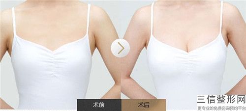 聚左旋乳酸去法令纹矫正副作用有哪些