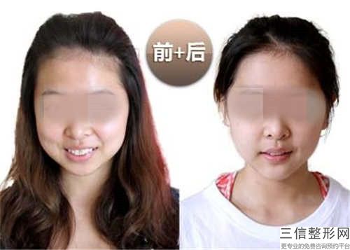 牙齿矫正改善厚嘴唇对宝宝有什么影响