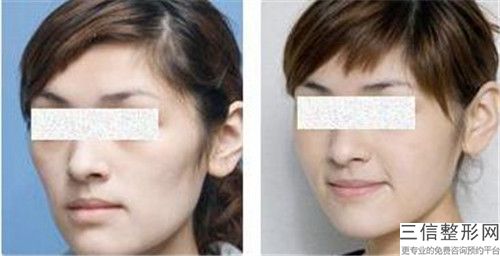 好的侧脸凹陷矫正整形医生中国：侧脸凹陷矫正医生50强实力预测
