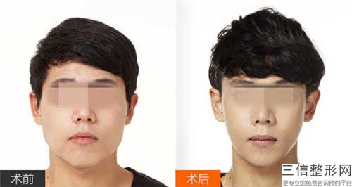 泰州高颧骨缩小术的后遗症