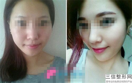 玻尿酸丰额头手术全国哪家医院好：玻尿酸丰额头手术医院前50佳榜单详解