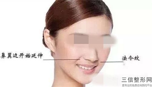 激光治疗妊娠纹去除术的安全性如何