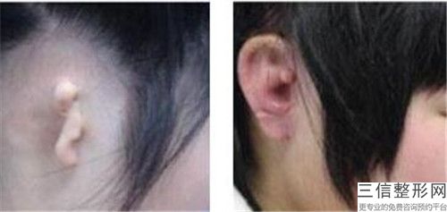 中国美容耳朵畸形做假耳朵医院：耳朵畸形做假耳朵医院前50专个横评