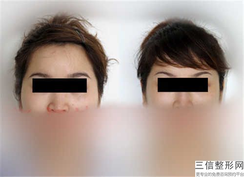 种植牙穿颧良好的医生王崇川区(沙小冬医生技术点评_附价格一览表)