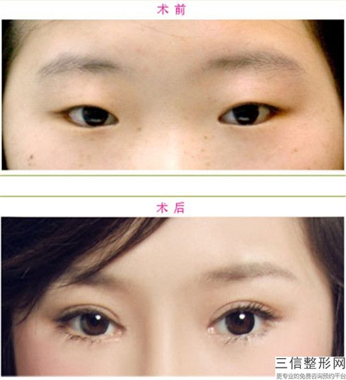 自体脂肪填充泪沟手术术能够维持多少年