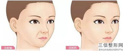 西安超声波除皱以后怎么护理
