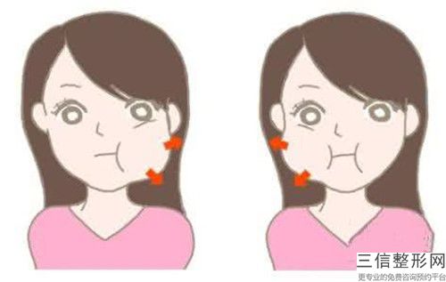 手术玻尿酸去法令纹拆线后有疤痕该如何处理