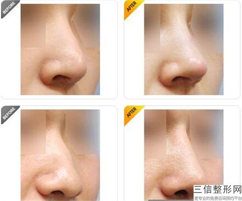 扬州鼻子整术后正常饮食受影响吗