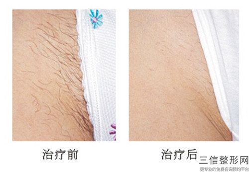 国内腿上激光脱毛哪里整形医院好：腿上激光脱毛医院前50强强榜官方发布
