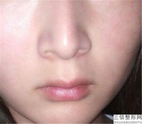 宁波市董栋医生,吴伟医生唇鼻二期修复你更中意哪一个