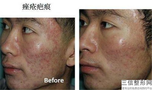 辽宁省谭佳男医生,刘东医生黄褐斑激光祛斑实力大PK
