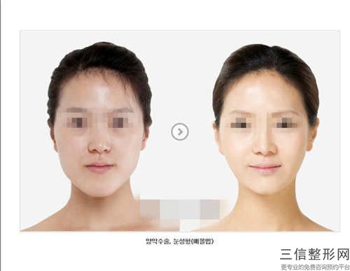 重庆市陈新医生,张道军医生兔唇二次手术修复各方技术和审美在线PK