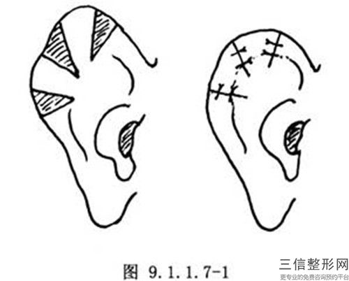 江门市正规外耳整形手术医院哪家更权威-江门市人民医院整形外科医生大咖口碑推荐