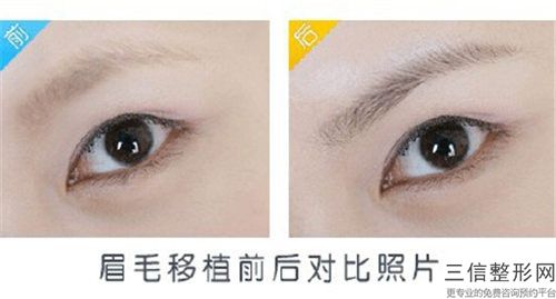 临汾市箭头眉毛整容医院排名榜-临汾市人民医院烧伤真实口碑反馈整理