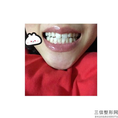 南京牙仙子口腔诊所满口假牙手术会出现哪些风险