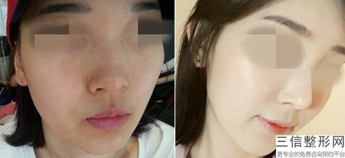 郑州整容鼻子鼻翼宽有何优势 能维持多久