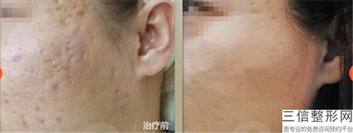 谢常礼做光子去斑会影响今后的怀孕吗